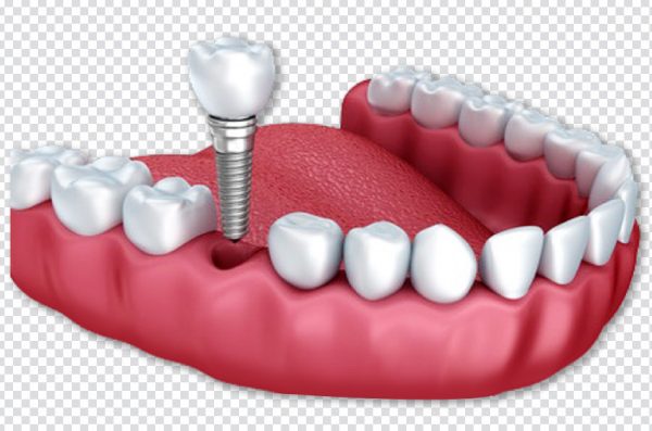Dental Implant, Dentistry, and Dentures PNG – Free Transparent Download