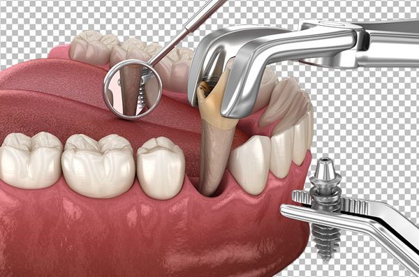 Tooth Extraction PNG – Free Transparent Download