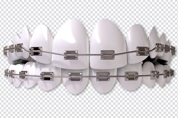 White Teeth with Braces PNG – Dentistry, Orthodontics, Dental Crown Free Download