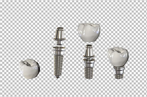 Dental Implant PNG – Transparent Tooth Implant Image Free Download