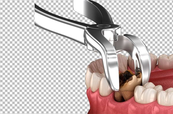 Transparent Tooth Extraction PNG – Free Download